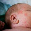 Чому у немовляти з'являються прищики на обличчі