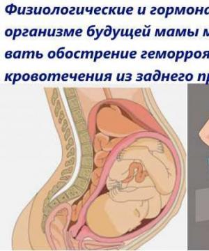 Особливості лікування геморою після пологів при грудному вигодовуванні