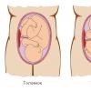 Peculiaridades del manejo de vagutnost y marquesinas en caso de posición pélvica del feto.
