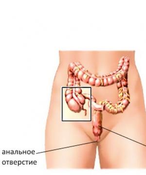 apendicitis durante el embarazo
