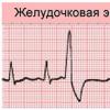 Kako otkriti skraćeno srce na kardiogramu?