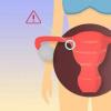 Egzama ve intrauterin tohumlama ile endometriozis: rahim endometriozisinin tedavisinde taktikler